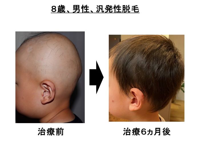 円形脱毛症　病院